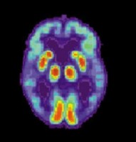 Alzheimer's PET scan PET Scan of Alzheimer's Disease Brain. (Credit: NIH/National Institute On Aging)