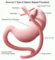 Gastric Bypass Surgery