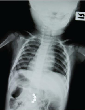Magnets inside the body Magnets inside the body