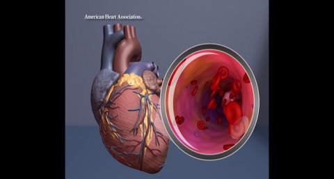 Heart illustration with artery close up. (American Heart Association)