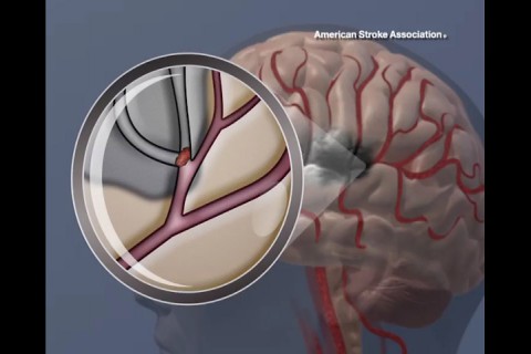 Blood flow blocked in brain. (American Heart Association)