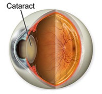 Cataract