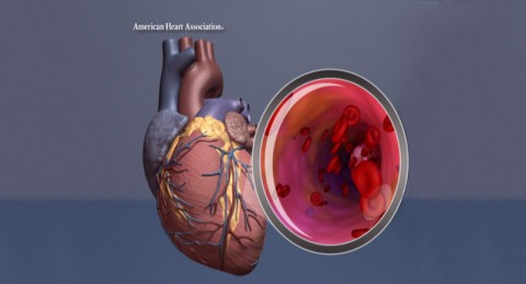 Heart illustration with artery close up. (American Heart Association)