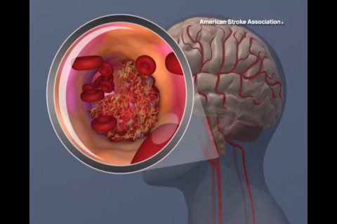 A blood clot forming in the carotid artery. (American Heart Association)