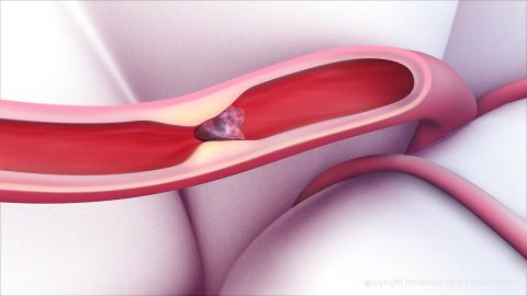 A clot within a blood vessel interrupting blood flow to the brain. (American Heart Association)