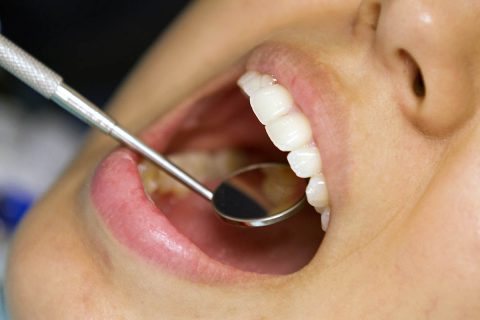 Having fewer natural teeth by middle age is linked to higher cardiovascular disease risk. (American Heart Association)