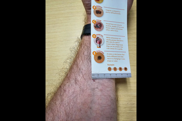 A Soldier uses a dermatology measuring tool to self-check a darkened spot on their arm. (BACH)